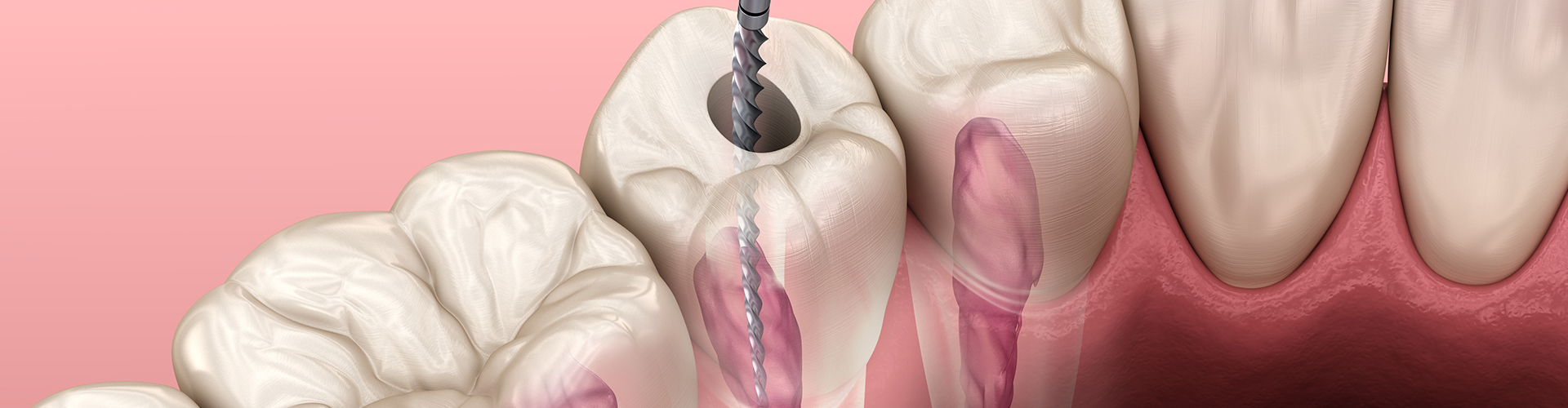 rendering of a root canal tool in a transparent tooth